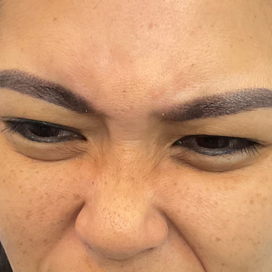 Bunny Lines Treatment