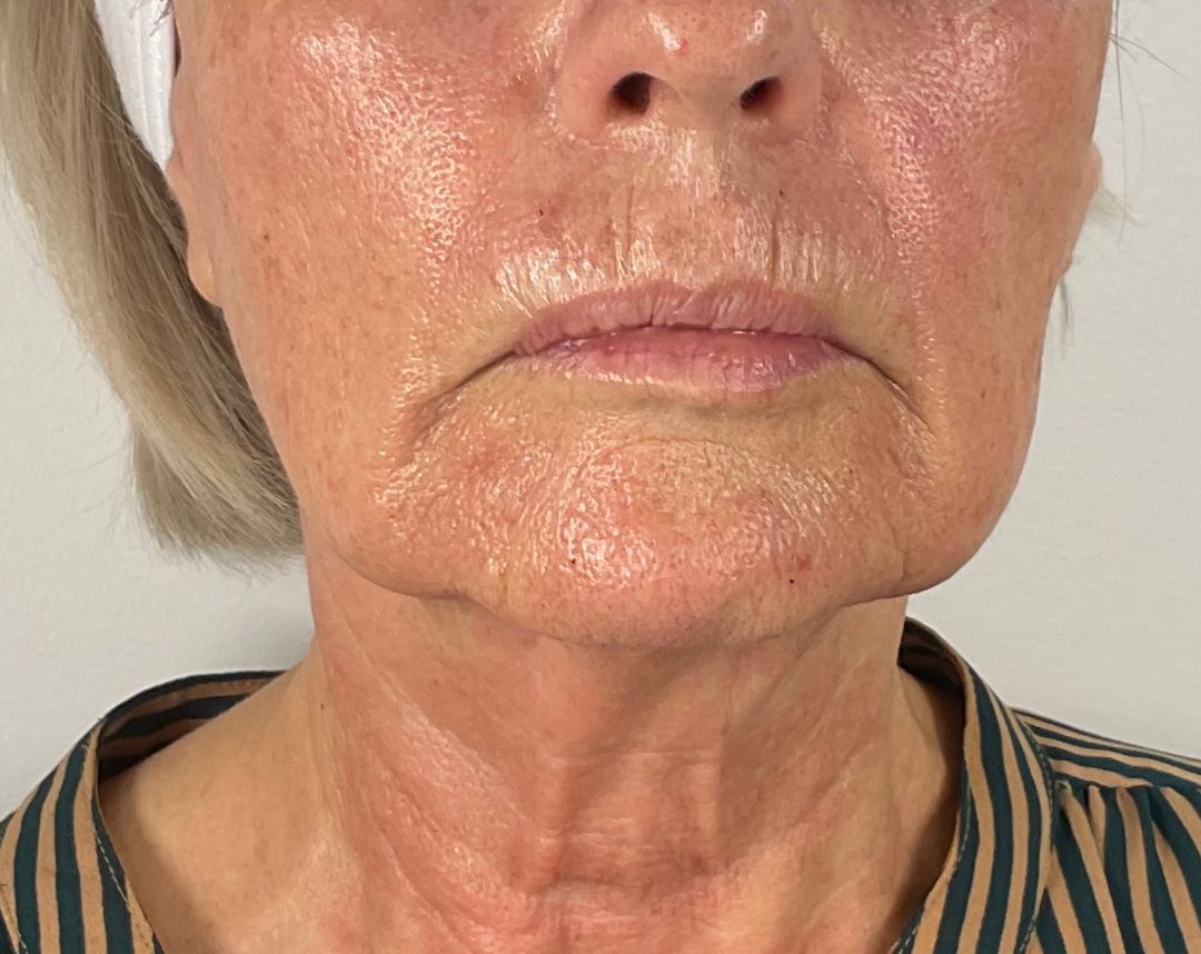 Potenza RF Microneedling