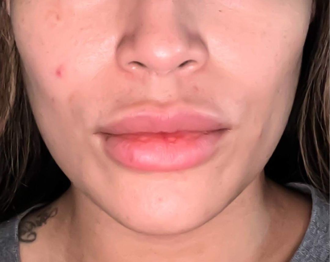 Jaw Slimming