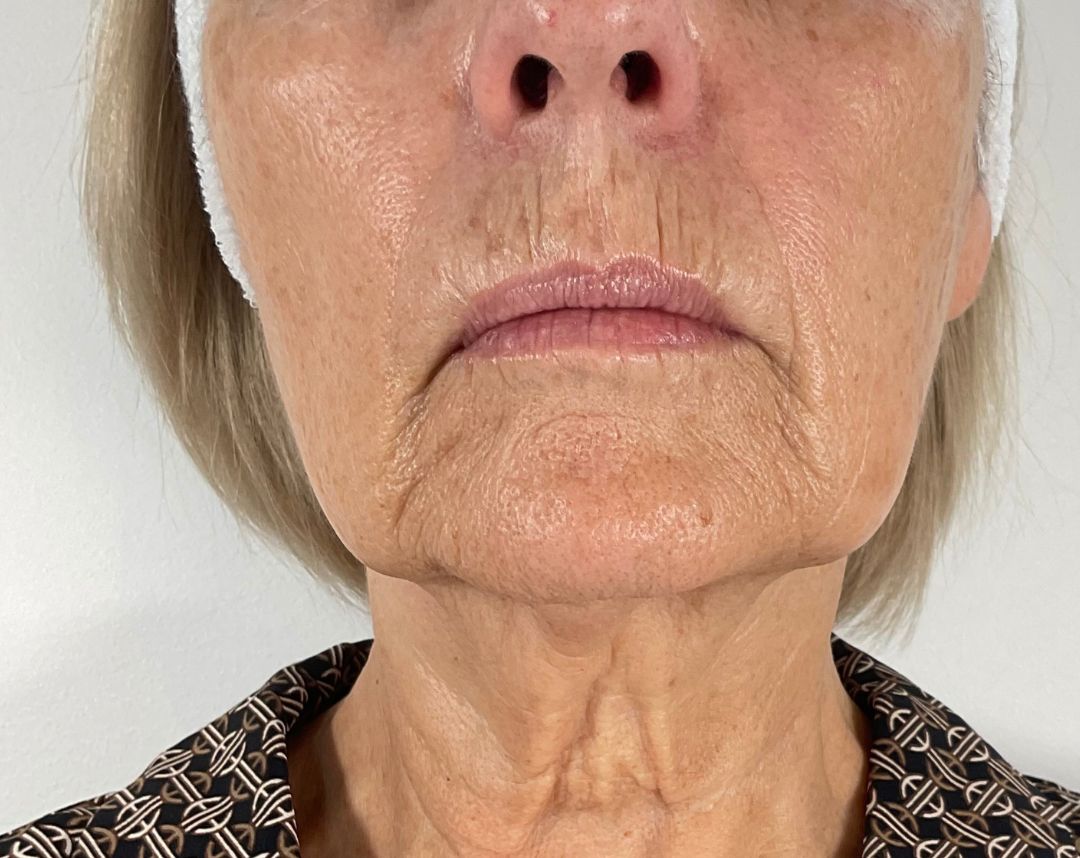 Potenza RF Microneedling