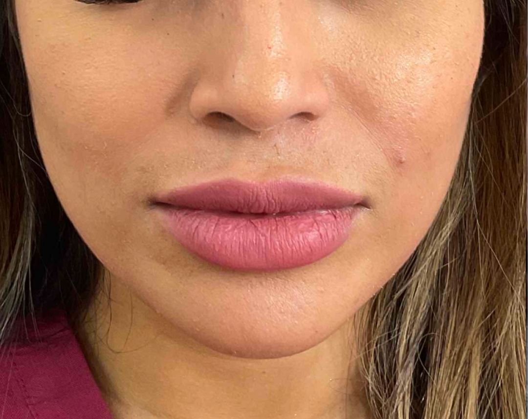 Jaw Slimming