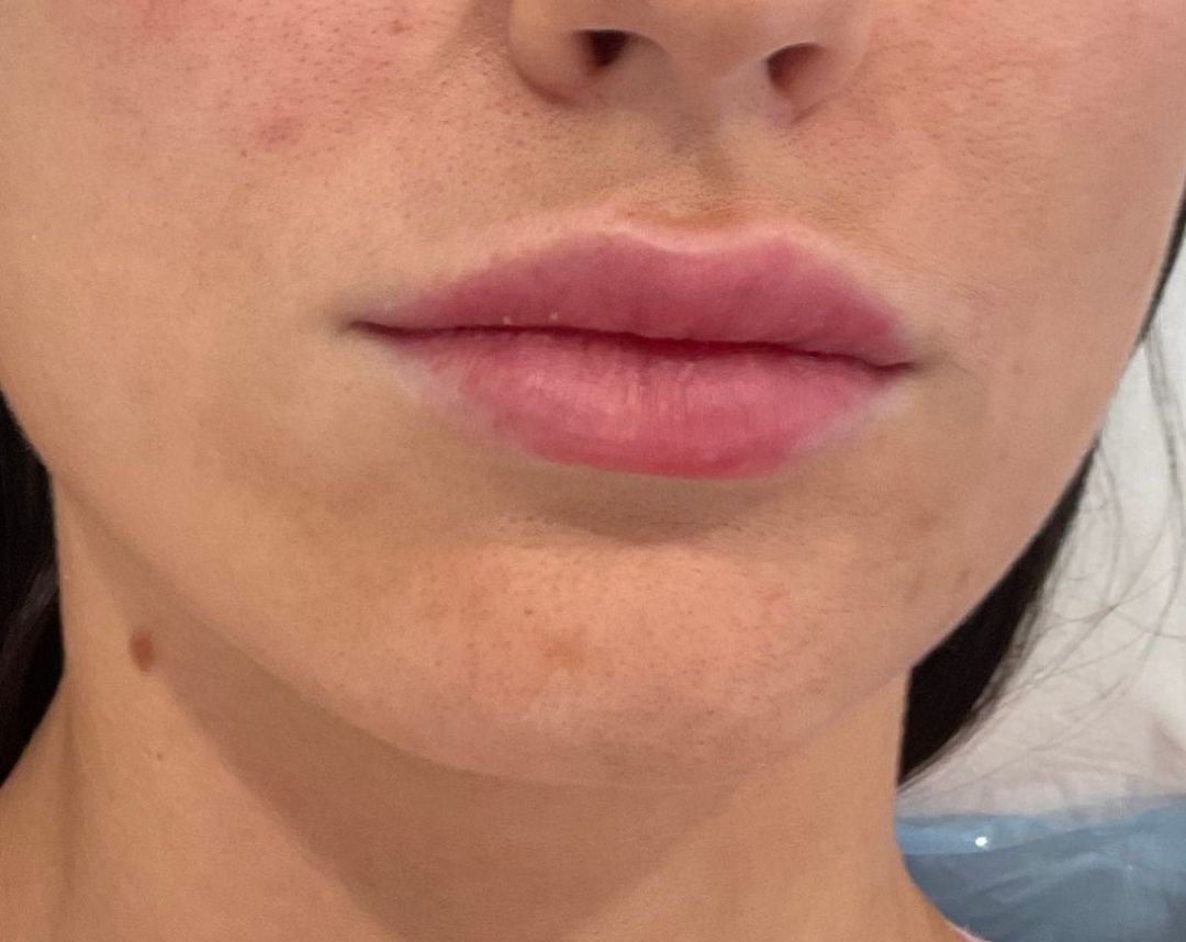 Lip Fillers