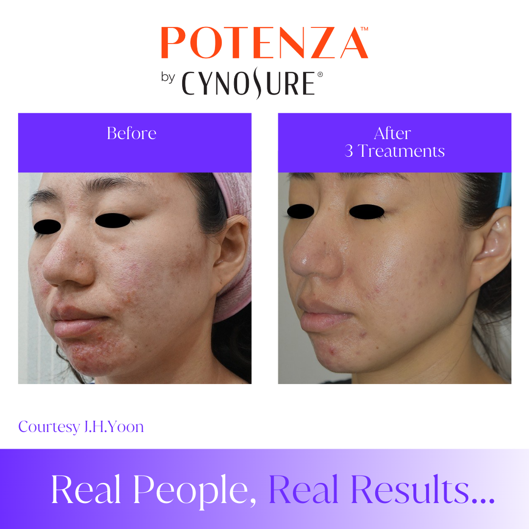 B2CJune4 RF microneedling machine